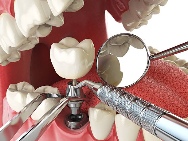 Best Emergency Root Canal Treatment in West Fargo, ND